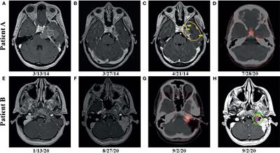 Germline BAP1 Mutation in a Family With Multi-Generational Meningioma With Rhabdoid Features: A Case Series and Literature Review